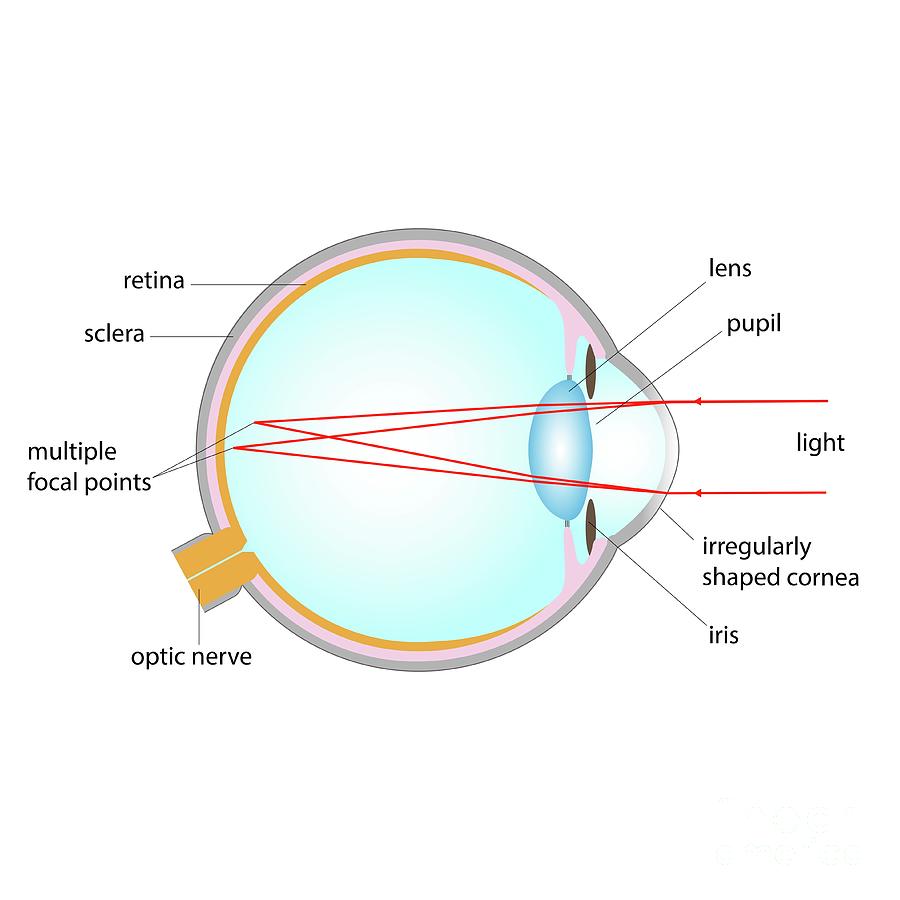 Astigmatism Photograph by Cordelia Molloy/science Photo Library | Fine ...