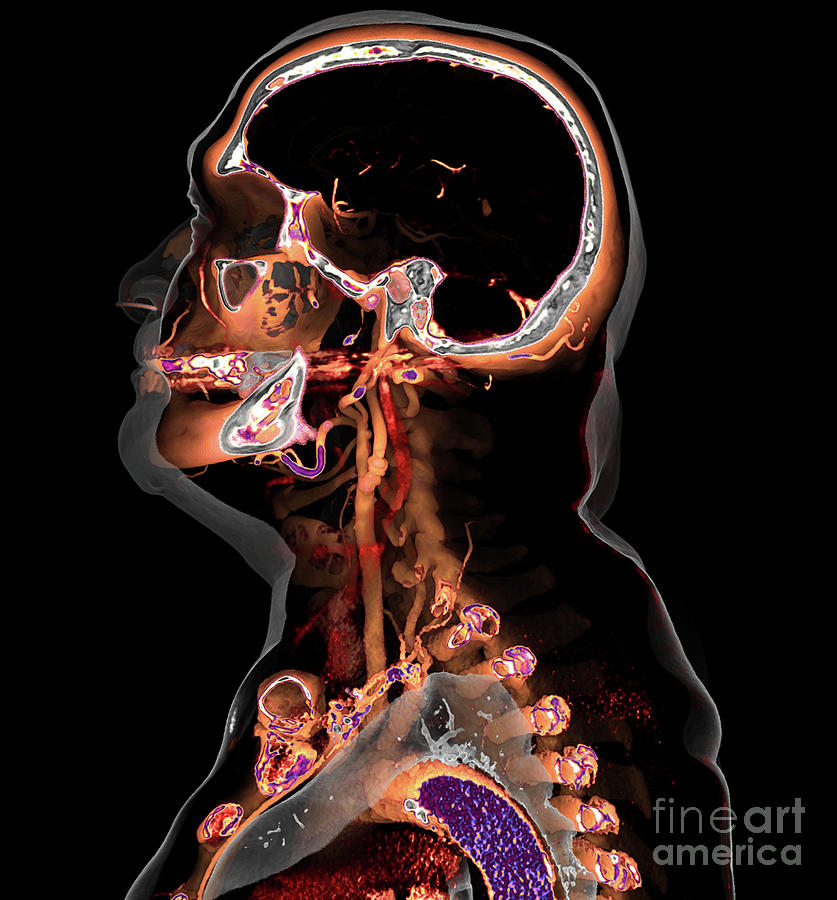 Atherosclerosis #3 Photograph by Vsevolod Zviryk/science Photo Library