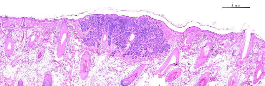 Basal Cell Carcinoma #3 Photograph by Jose Calvo/science Photo Library