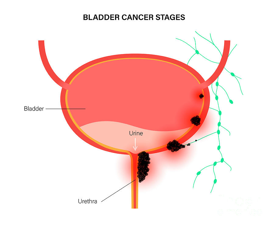 Bladder Cancer Stages Photograph by Pikovit / Science Photo Library ...