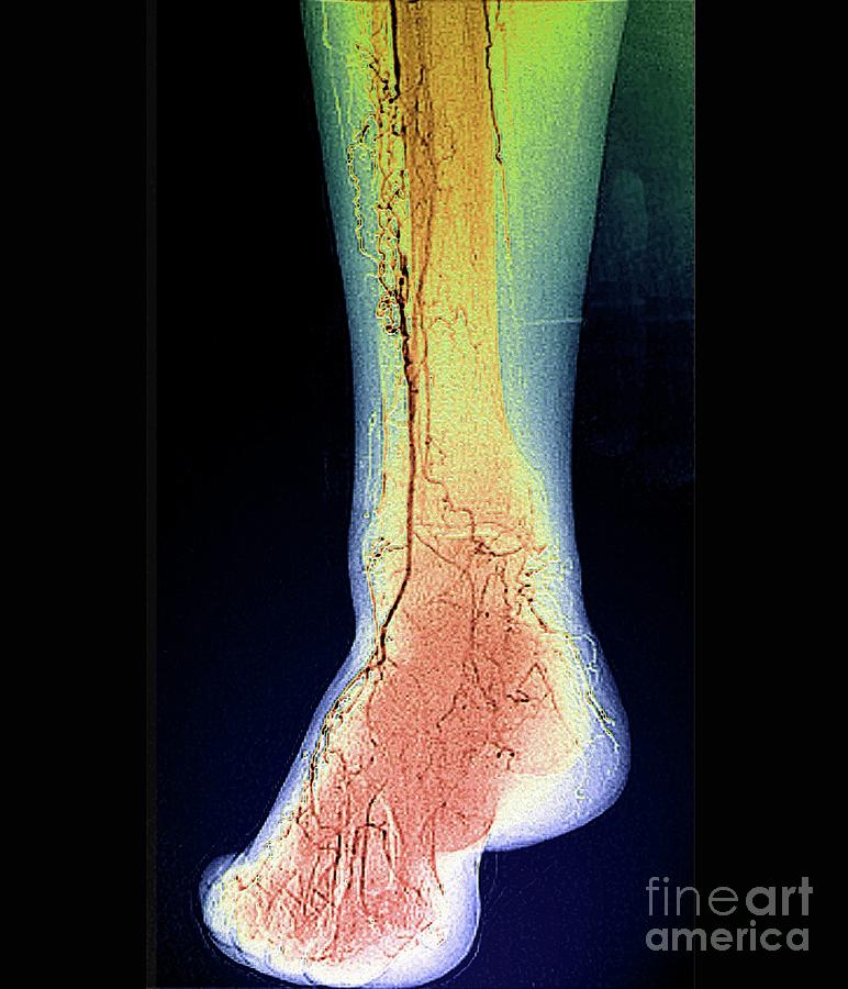 Blocked Leg Artery Photograph By Zephyrscience Photo Library Fine