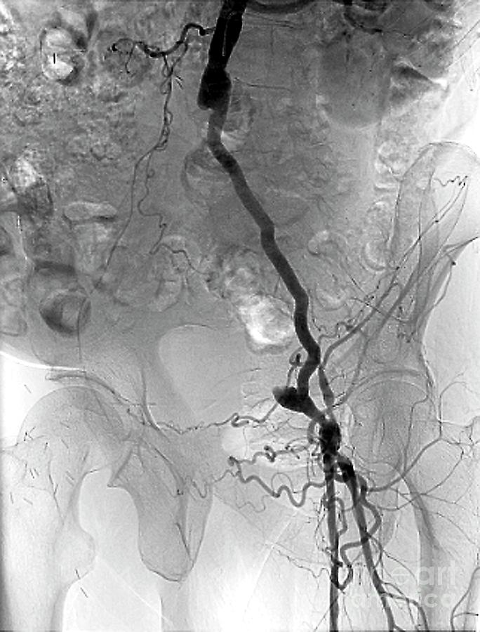 Blocked Pelvic Artery #3 Photograph by Zephyr/science Photo Library