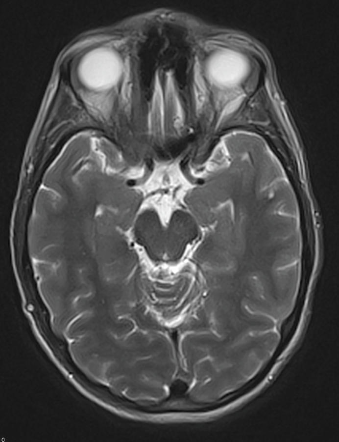 Brain Cancer Treated, Mri #3 Photograph by Steven Needell