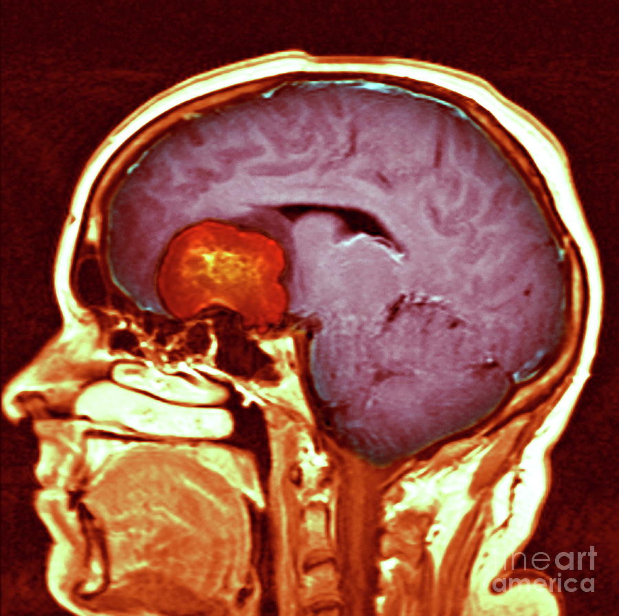 Brain Tumour Photograph By Simon Fraser/newcastle Hospitals Nhs Trust ...