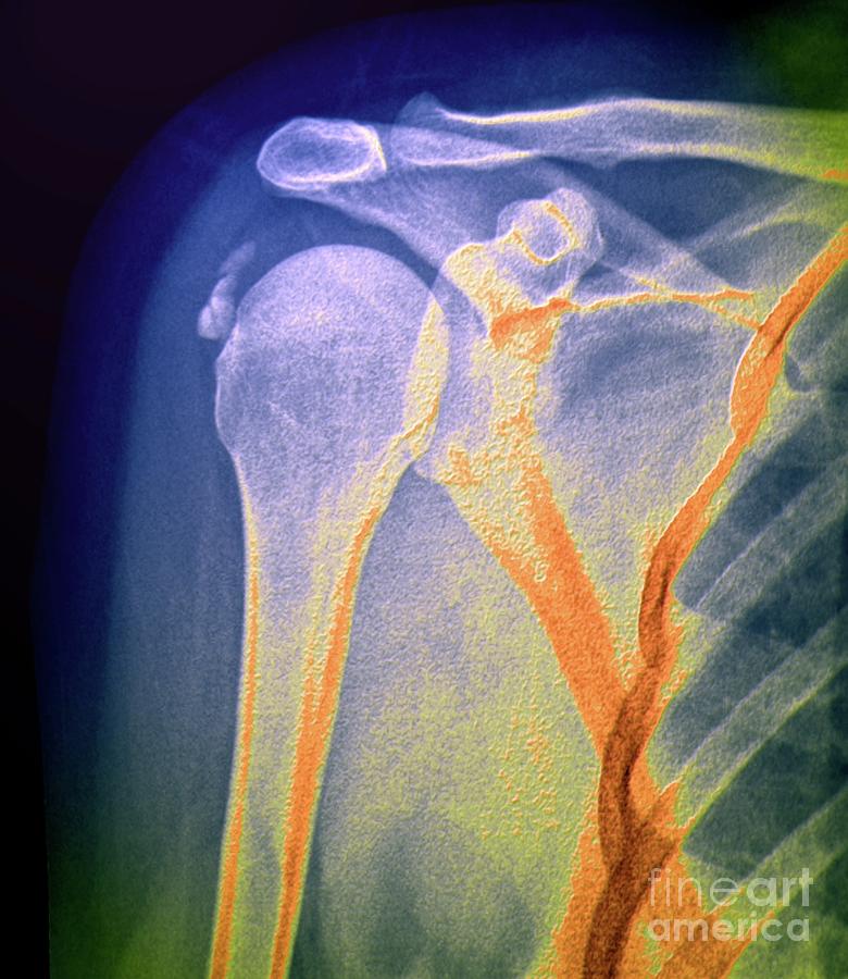 Calcified Tendinitis #3 Photograph by Zephyr/science Photo Library