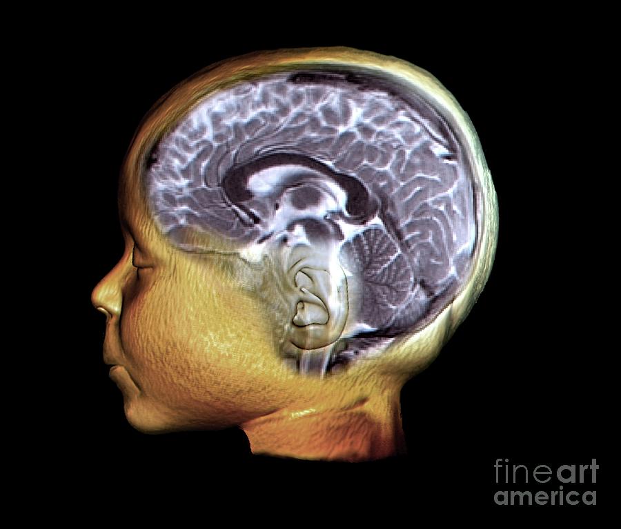 Childs Head And Brain #3 Photograph by Zephyr/science Photo Library