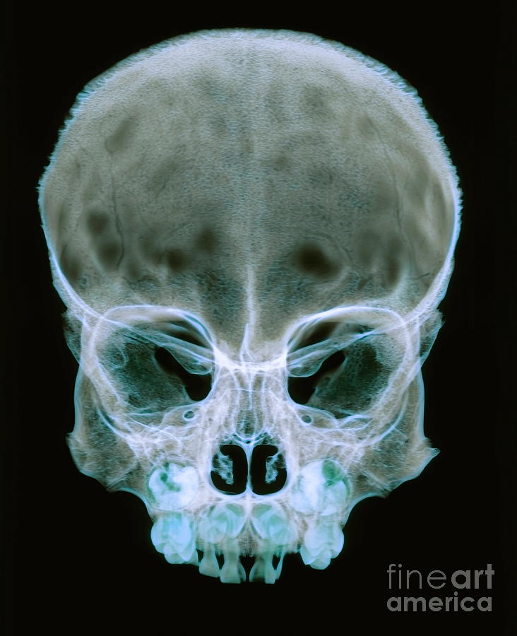 Skull Photograph - Childs Skull #3 by D. Roberts/science Photo Library