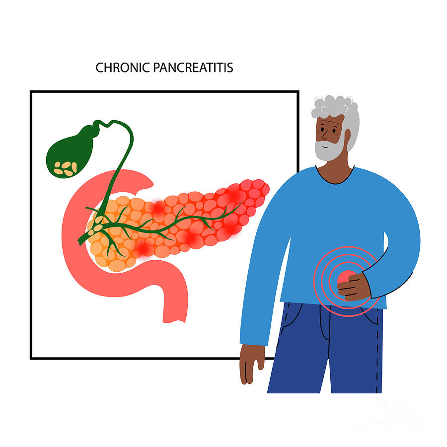 Chronic Pancreatitis #3 Photograph by Pikovit / Science Photo Library