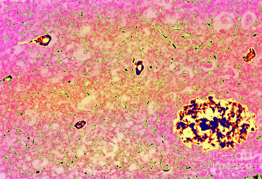 Coloured Lm Of Alzheimer S Disease Brain Tissue Photograph By Simon Fraser Science Photo Library