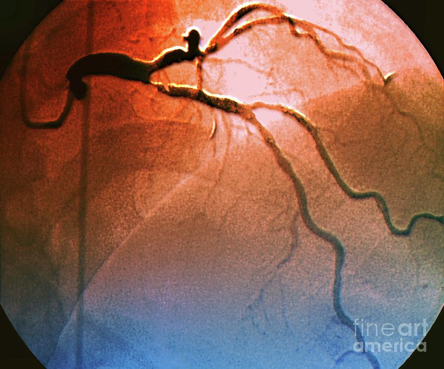Disease Photograph - Coronary Artery Stenosis #3 by Zephyr/science Photo Library