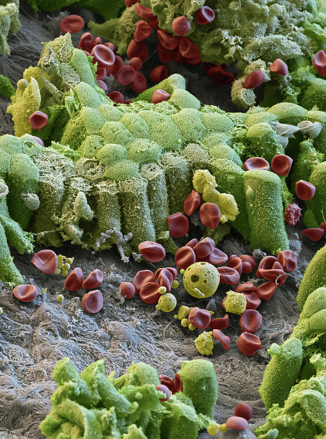 Damaged Gallbladder, Sem Photograph by Eye of Science