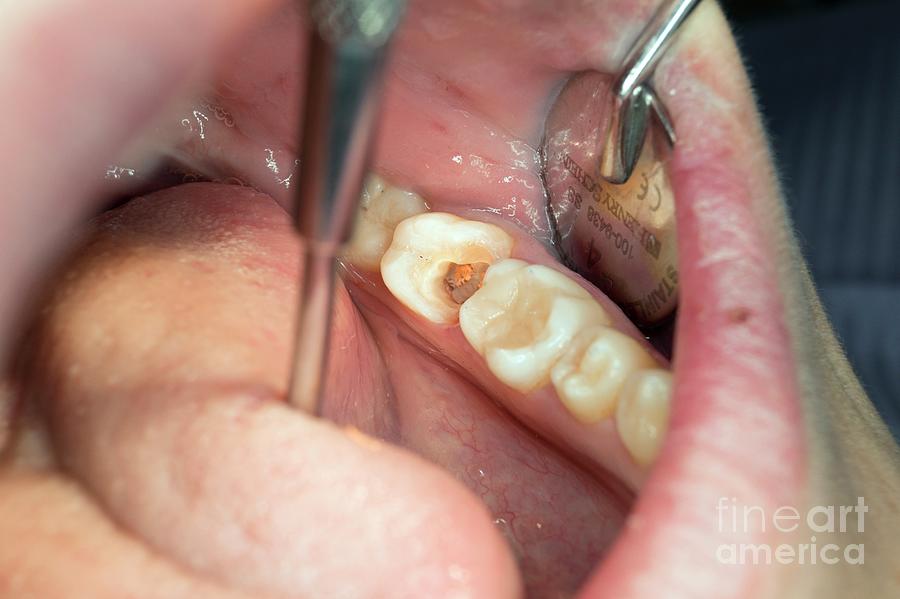 Dental Filling Photograph By Dr Armen Taranyanscience Photo Library