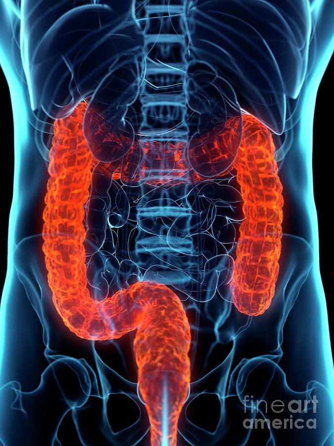 Diseased Colon Photograph By Sebastian Kaulitzkiscience Photo Library Fine Art America 9874