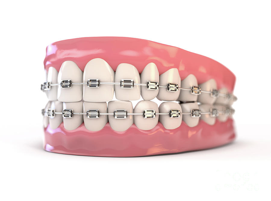Fake Teeth Set With Braces Digital Art