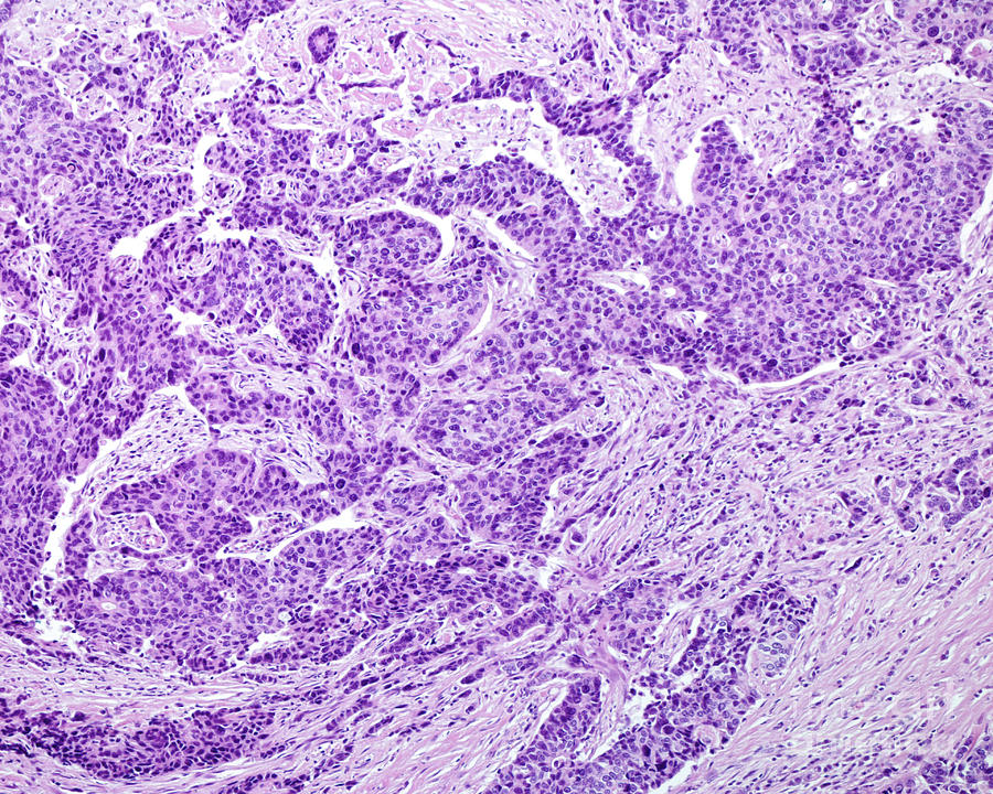 Gastric Adenocarcinoma #3 Photograph by Jose Calvo / Science Photo Library
