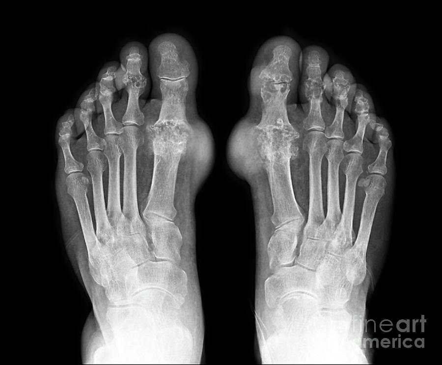 Gout Photograph by Zephyr/science Photo Library - Fine Art America