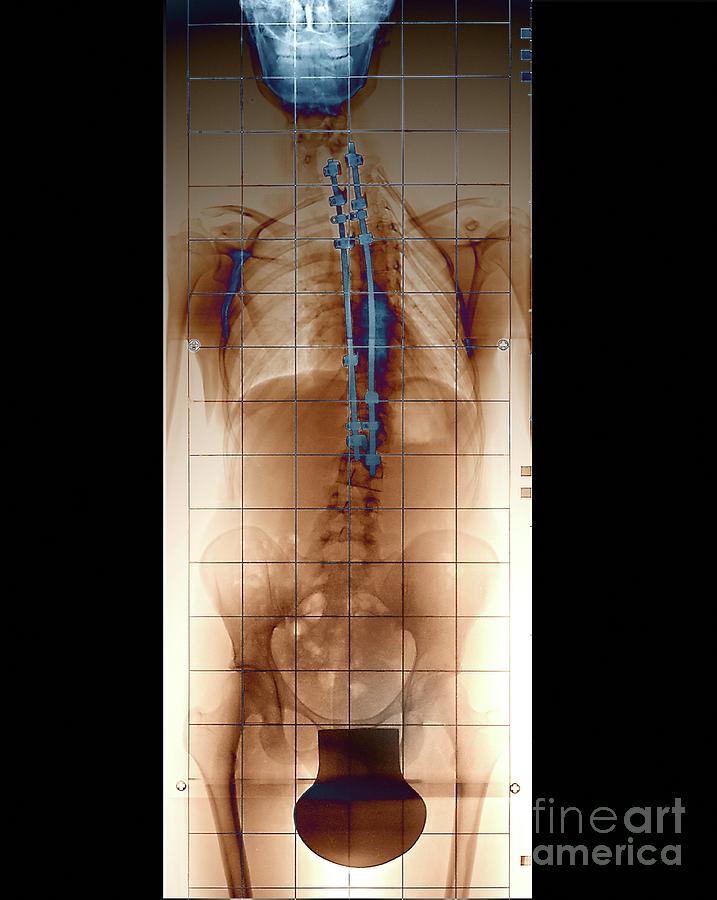 Harrington Rod Spinal Implants In Scoliosis #3 Photograph by Zephyr/science Photo Library