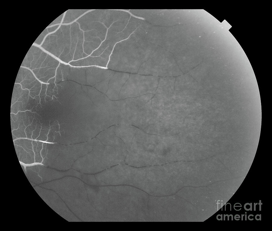 Hemispheric Retinal Artery Occlusion Photograph by Alan Frohlichstein ...