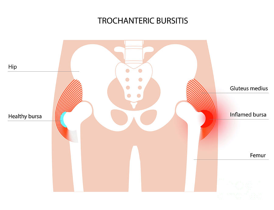 Bursitis of the hip joint - Stock Image - C011/0413 - Science Photo Library