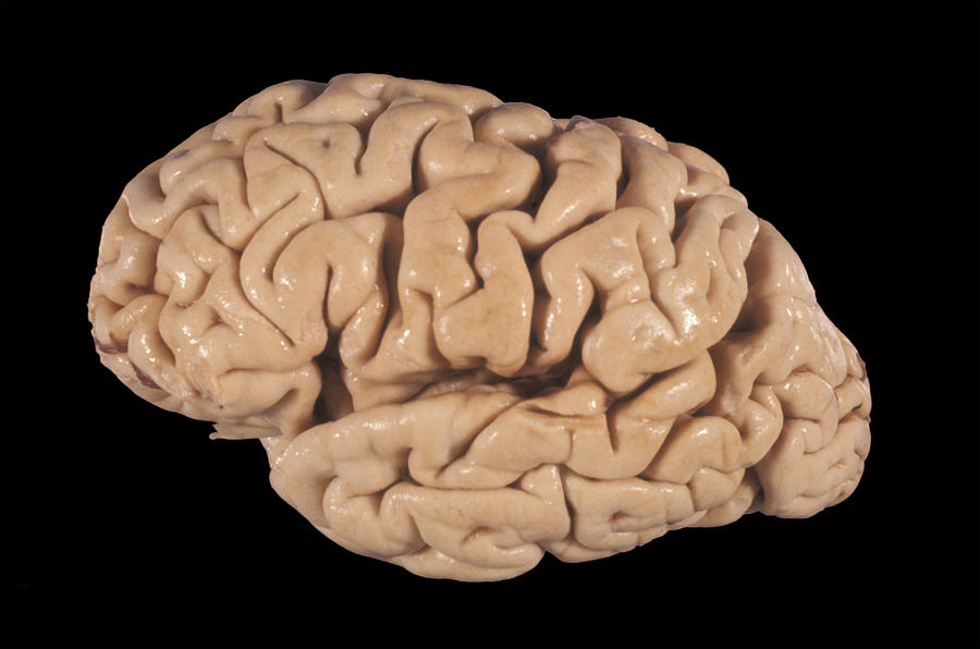 Human Brain, Cortical Atrophy #3 Photograph by Jose Luis Calvo