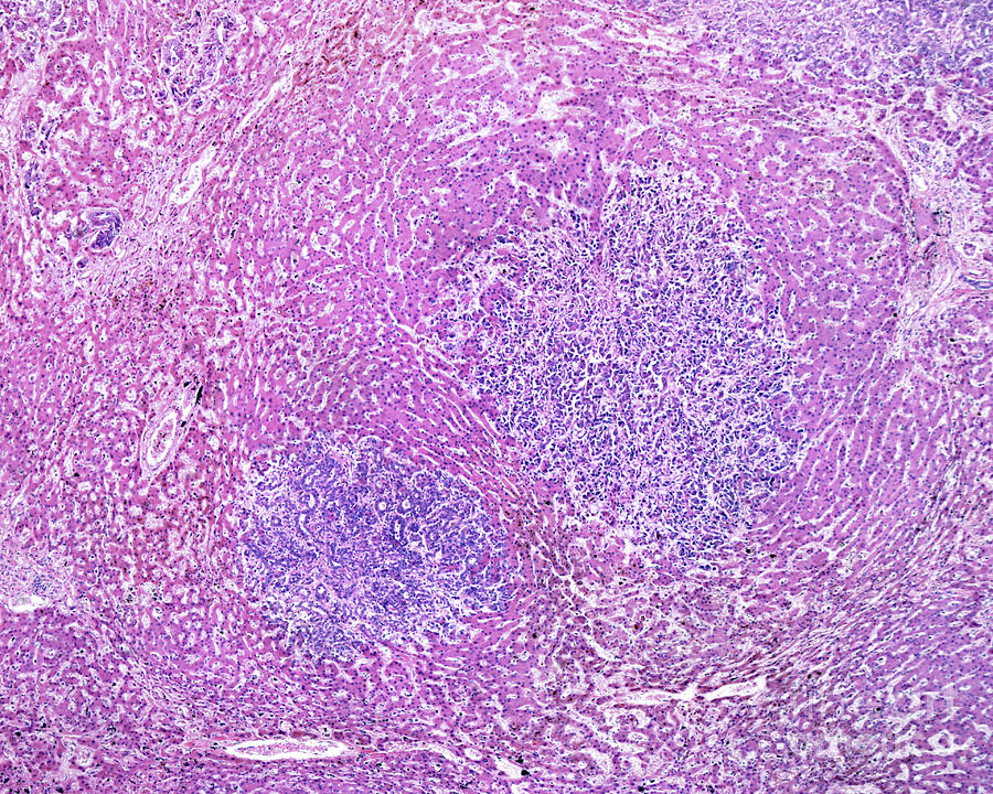 Human Liver Carcinoma #3 by Jose Calvo / Science Photo Library