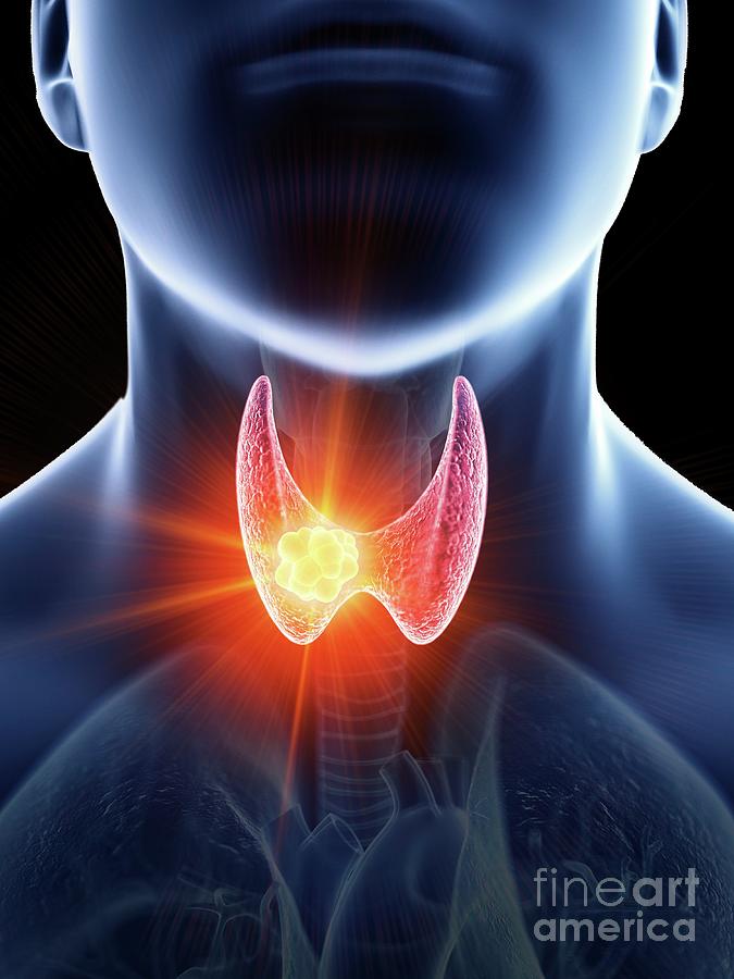 Illustration Of A Man's Thyroid Gland Cancer Photograph by Sebastian ...