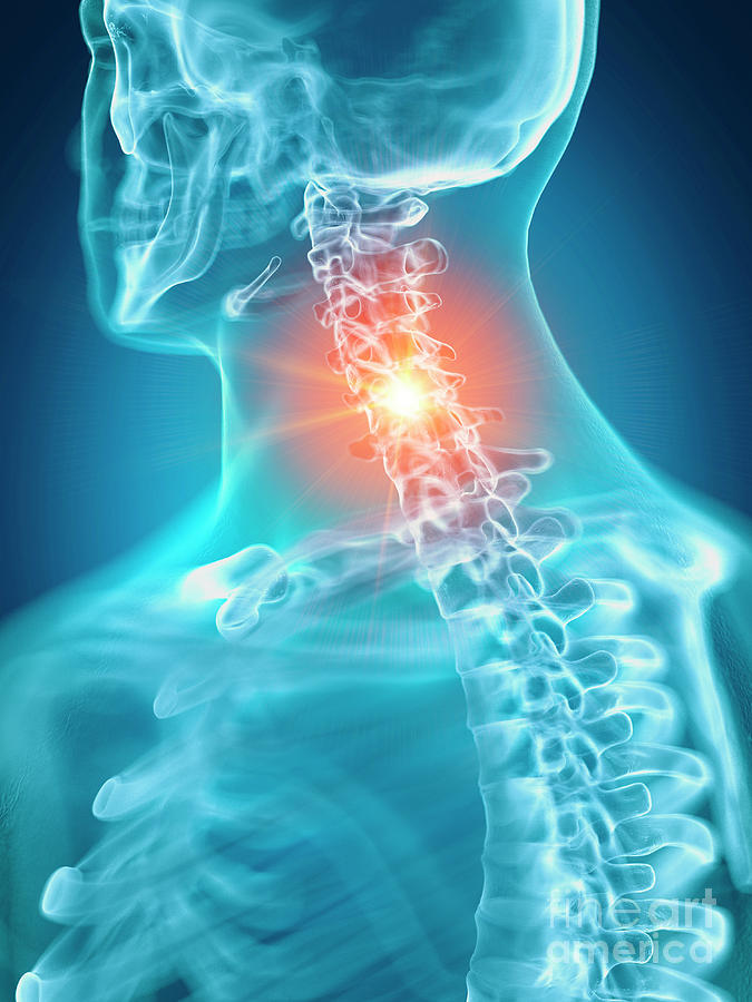 Illustration Of A Painful Cervical Spine #3 by Sebastian Kaulitzki ...