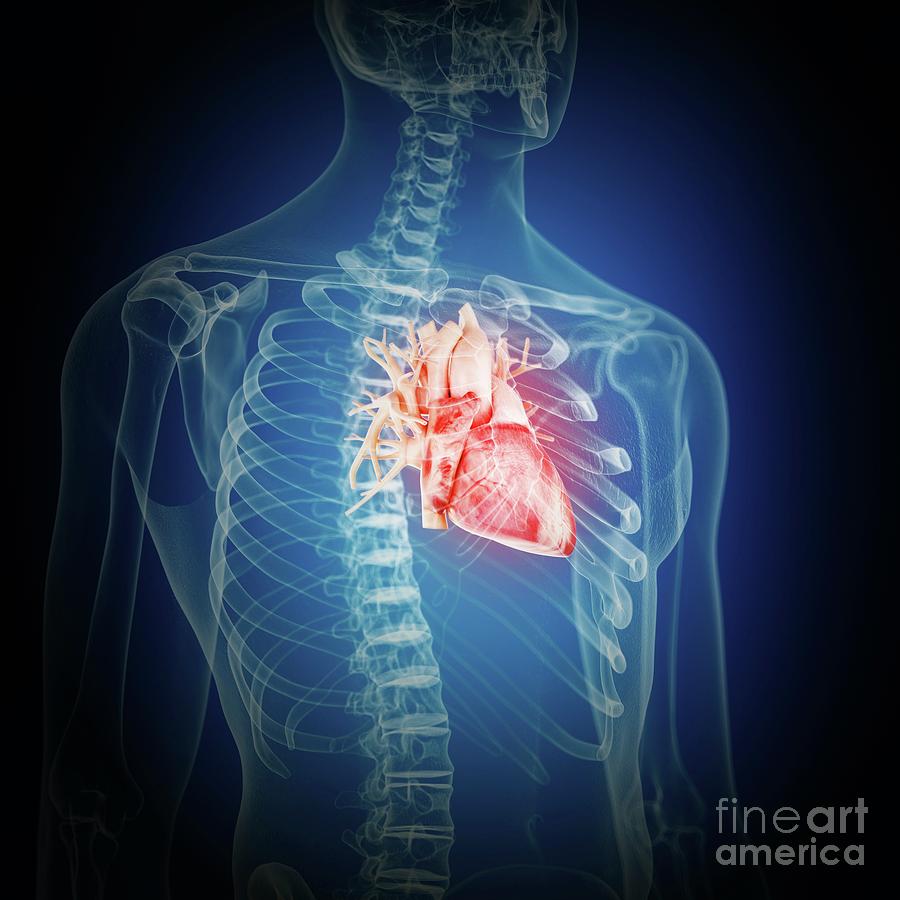 Skeleton Photograph - Illustration Of An Inflamed Heart #3 by Sebastian Kaulitzki/science Photo Library
