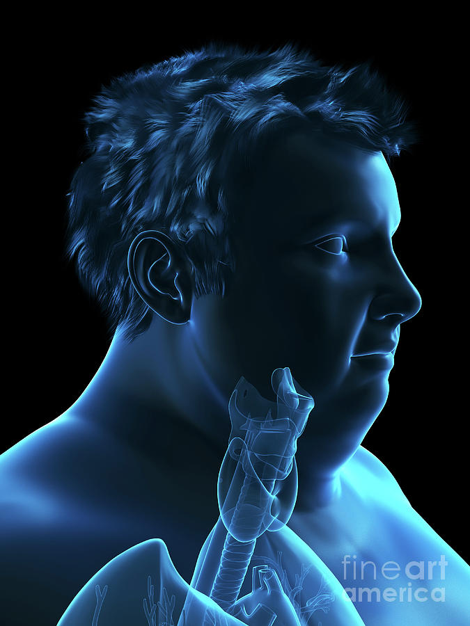 3d Photograph - Illustration Of An Obese Mans Throat Anatomy by Sebastian Kaulitzki/science Photo Library 3d Photograph - Illustration Of An Obese Mans Throat Anatomy by Sebastian Kaulitzki/science Photo Library