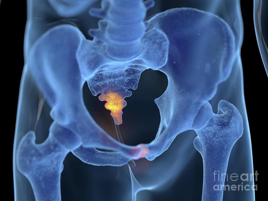 Inflamed Coccyx Photograph by Sebastian Kaulitzki/science Photo Library ...