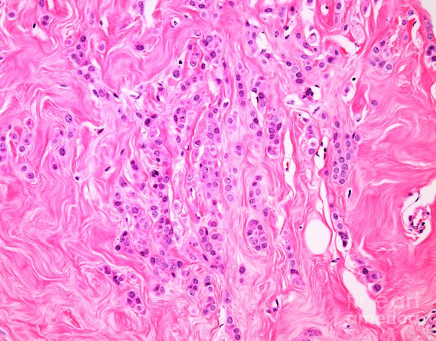 Invasive Lobular Breast Cancer Photograph By Webpathology Science Photo Library