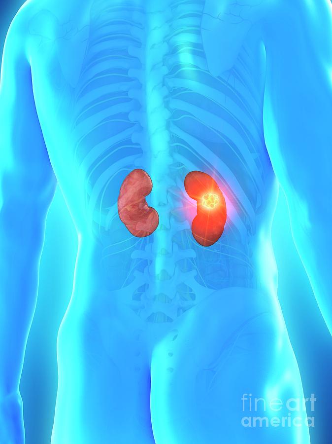 3d Photograph - Kidney Cancer #3 by Sebastian Kaulitzki/science Photo Library