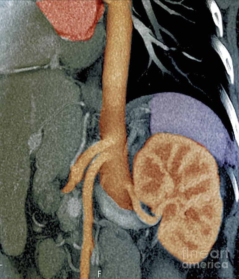 Kidney In Marfan Syndrome #3 Photograph by Zephyr/science Photo Library
