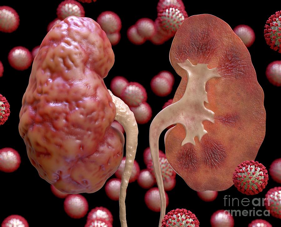 Kidney Inflammation In Covid-19 Photograph by Tim Vernon / Science ...