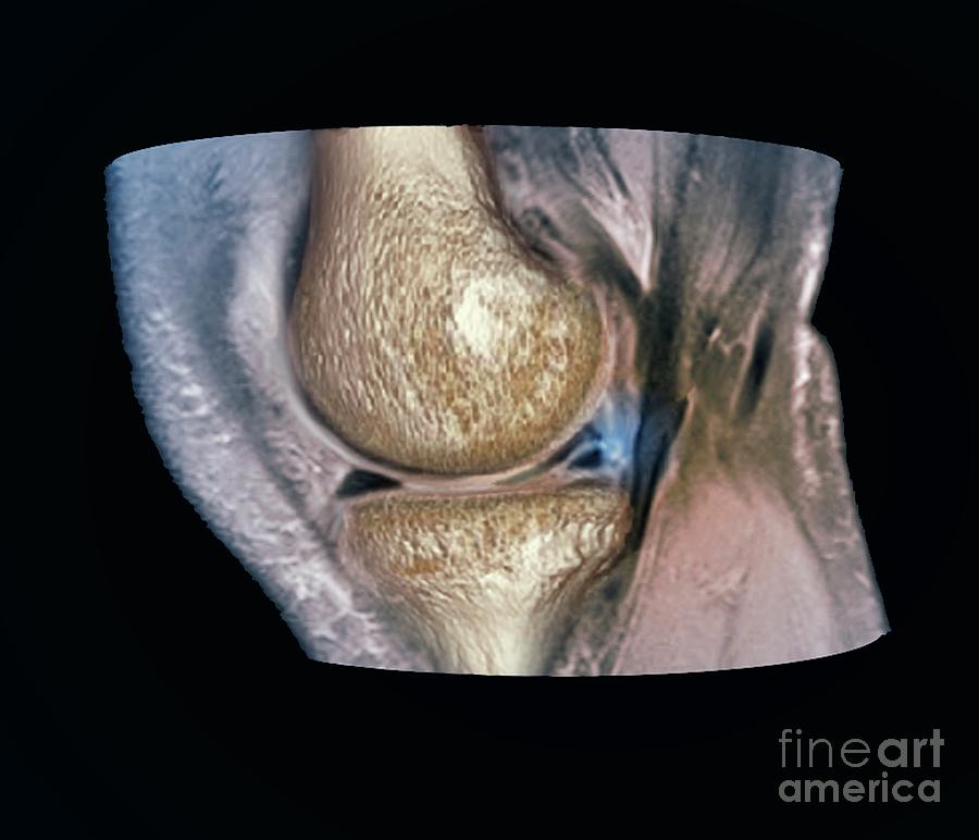Knee Meniscus Injury #3 Photograph by Zephyr/science Photo Library