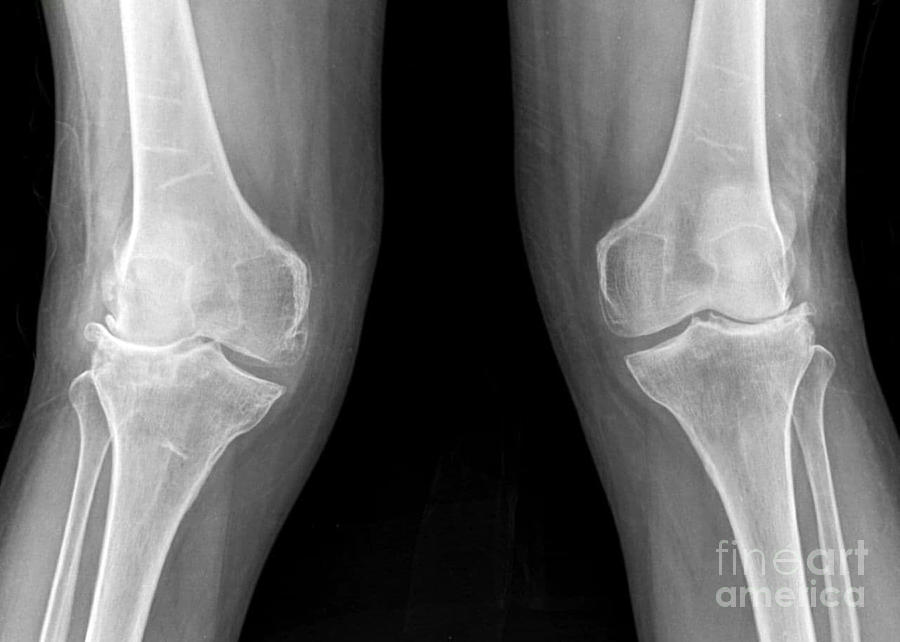https://images.fineartamerica.com/images/artworkimages/mediumlarge/2/3-knee-osteoarthritis-rajaaisyascience-photo-library.jpg
