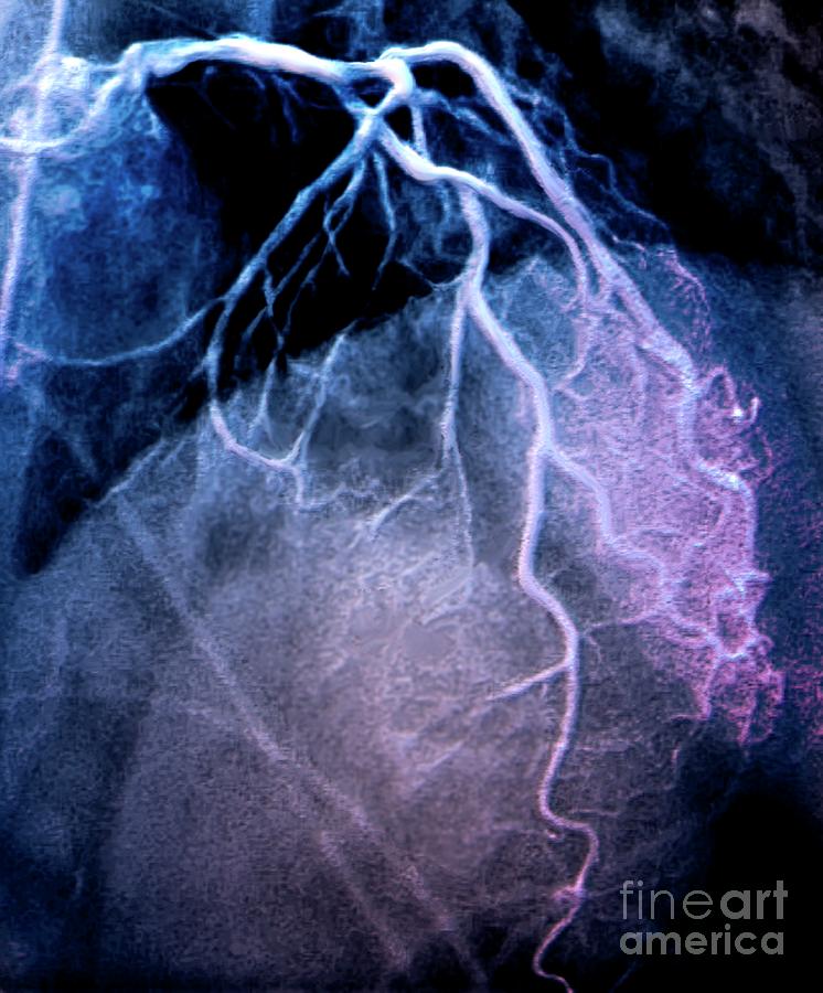 Human Body Photograph - Left Coronary Artery Network #3 by Zephyr/science Photo Library