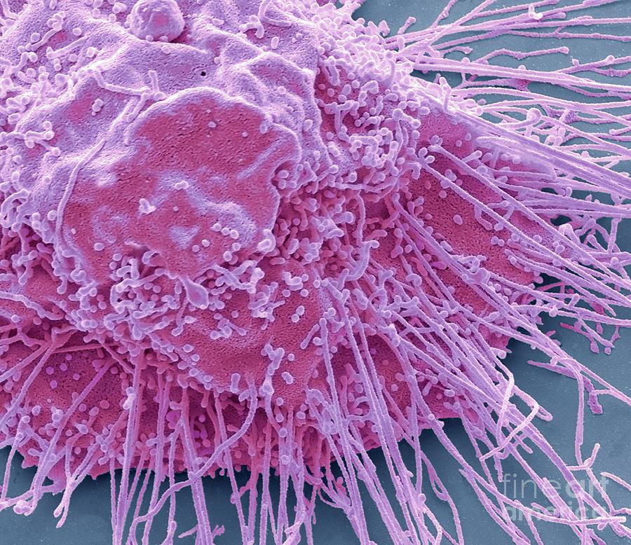 Liver Cancer Cell Photograph by Steve Gschmeissner/science Photo ...