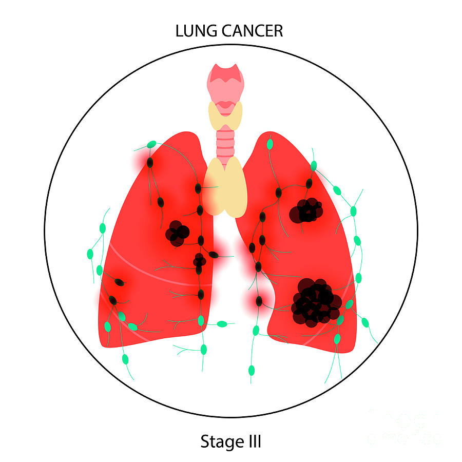 Lungs Cancer Photograph by Pikovit / Science Photo Library - Fine Art ...