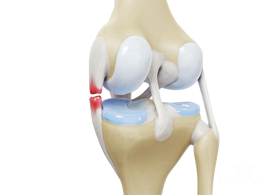 Medial Collateral Ligament Tear #3 Photograph by Medical Graphics/michael Hoffmann/science Photo Library Medial Collateral Ligament Tear #3 Photograph by Medical Graphics/michael Hoffmann/science Photo Library