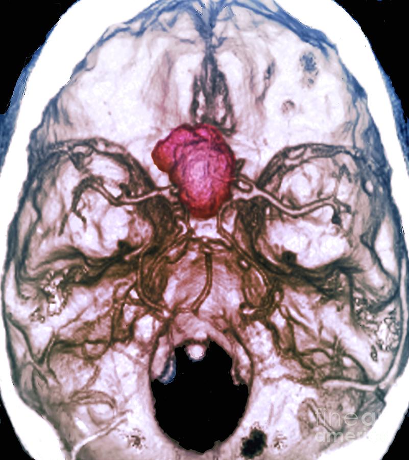 Meningioma Brain Cancer #3 By Zephyr/science Photo Library