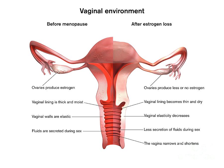 Menopause Vaginal Effects Photograph by Gunilla Elam/science Photo