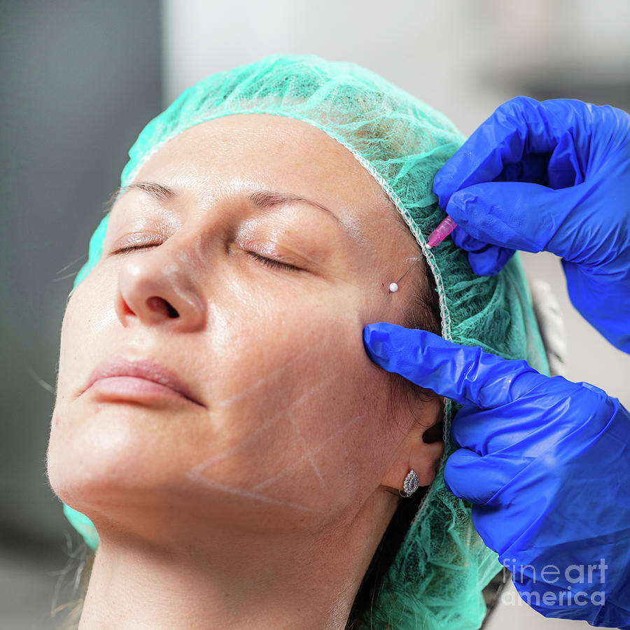 Mesotherapy Thread Face Lift Procedure #3 Photograph by Microgen Images/science Photo Library