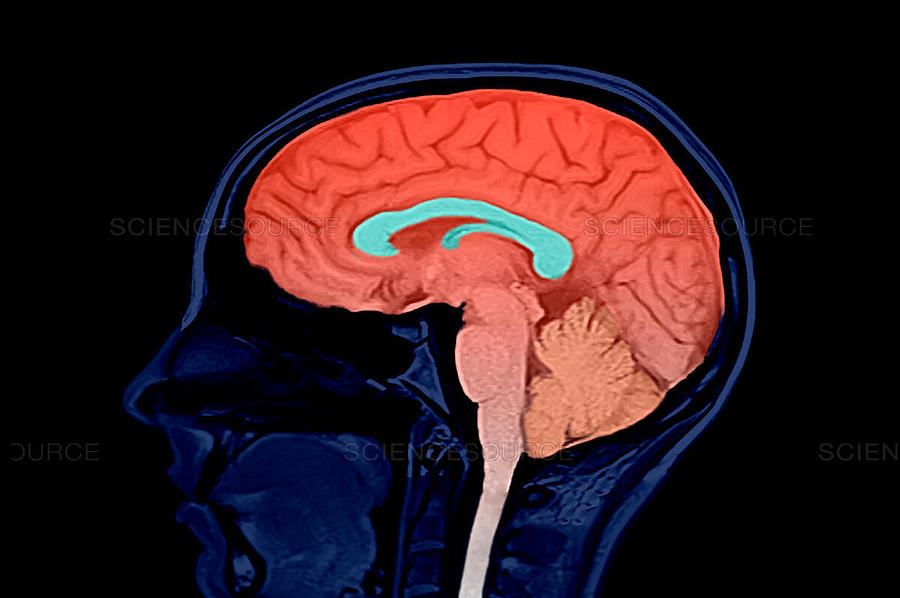 Mri Of Human Brain, Sagittal View Photograph by Kul Bhatia - Pixels