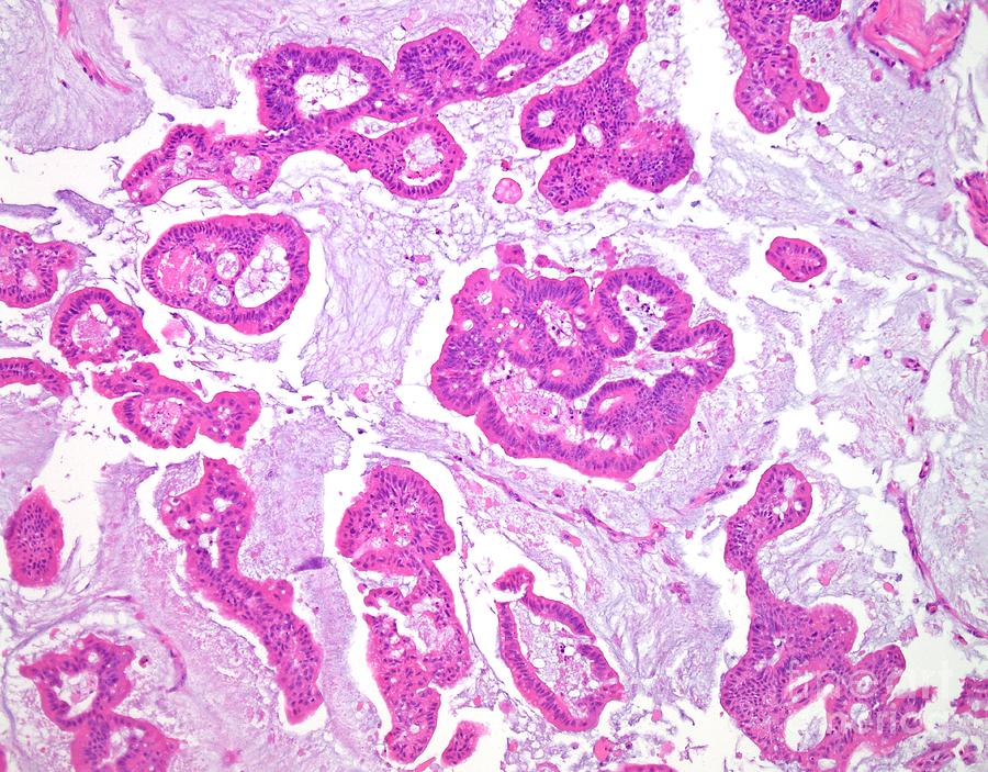 Mucinous Carcinoma Of The Colon Photograph by Webpathology/science ...