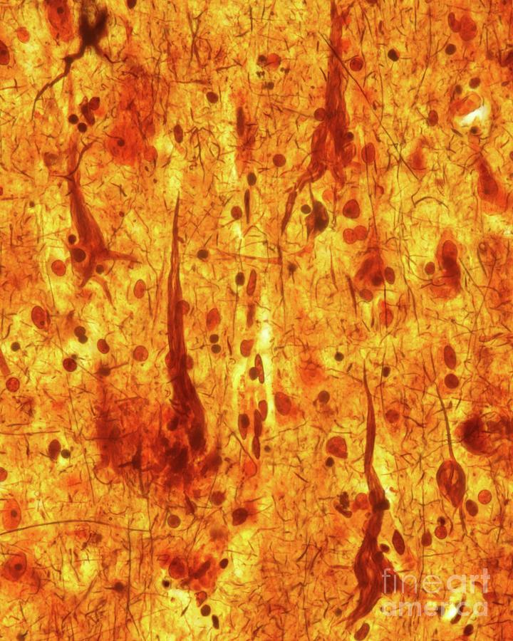 Neurofibrillary Tangles #3 Photograph by Jose Calvo / Science Photo Library