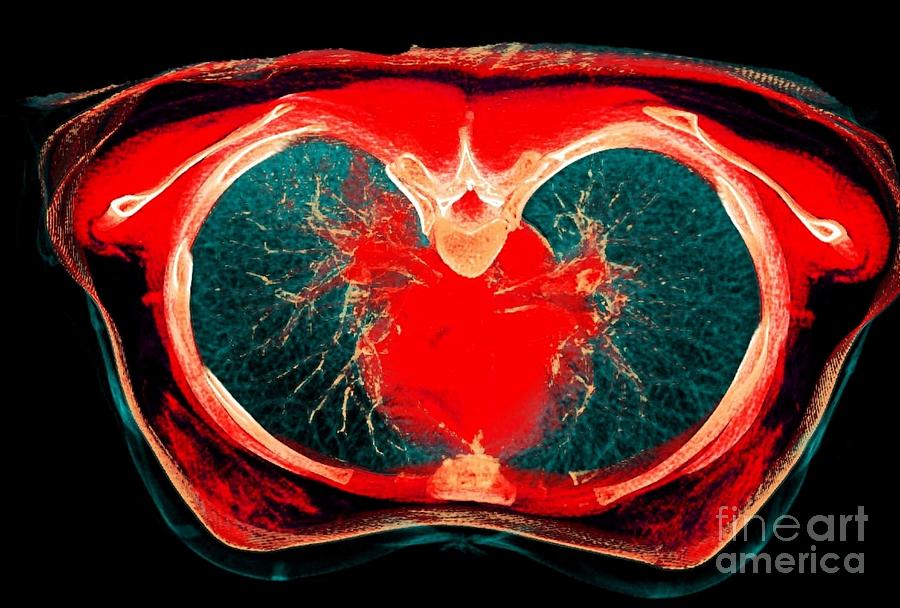 Normal Lung #3 Photograph by Rajaaisya/science Photo Library - Fine Art ...