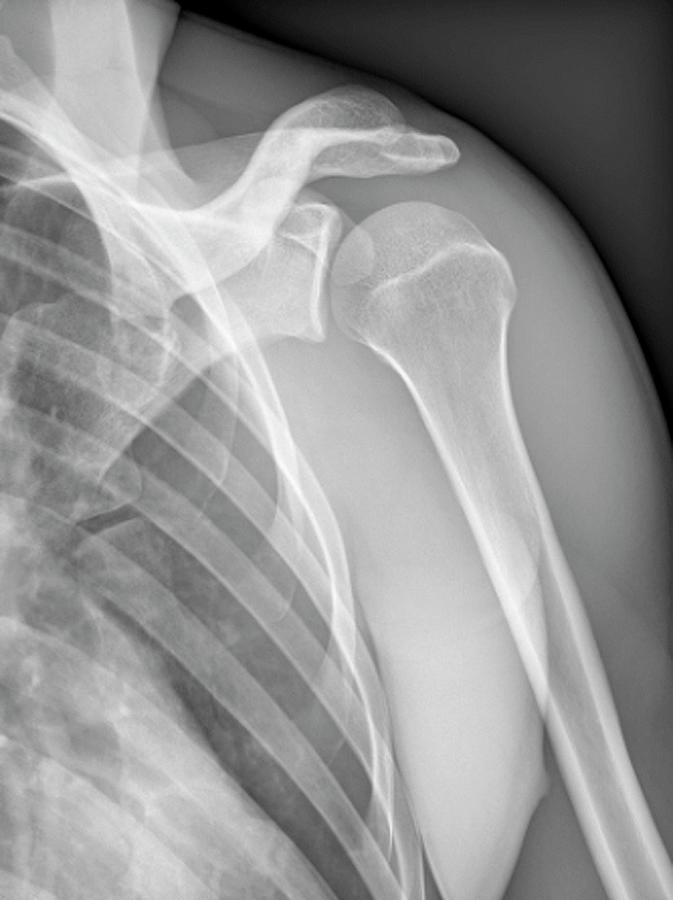 Normal Shoulder, X-ray Photograph by Zephyr