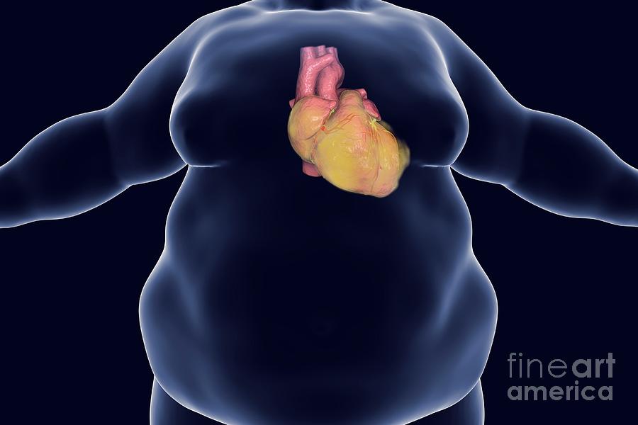 Obese Mans Heart Photograph By Kateryna Konscience Photo Library