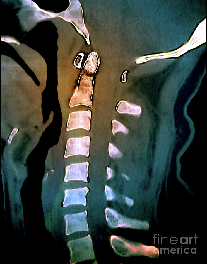Odontoid Process Fracture #3 Photograph by Zephyr/science Photo Library